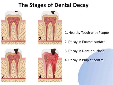 Dental Decay - Bargara Dentist Bundaberg Dentist