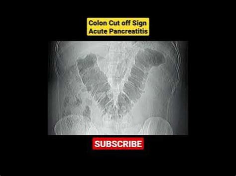 Colon Cut off Sign _ Acute Pancreatitis - X-Ray - YouTube