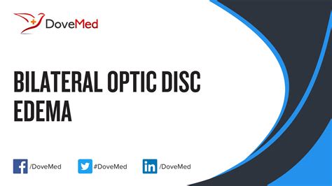 Bilateral Optic Disc Edema