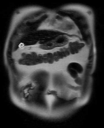 Pearl necklace sign | Radiology Reference Article | Radiopaedia.org