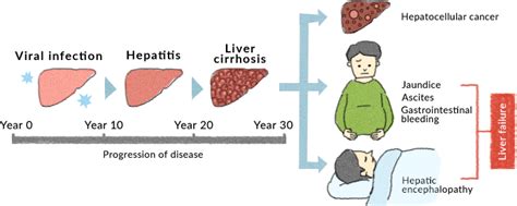 Liver Cancer Symptoms Vomiting : Liver cancer symptoms: Stomach pain ...