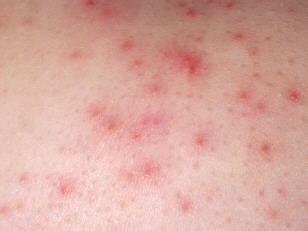 strep skin infection pictures - pictures, photos