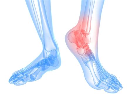 Foot and Ankle Arthritis - Corona Foot and Ankle | Wound Care Center