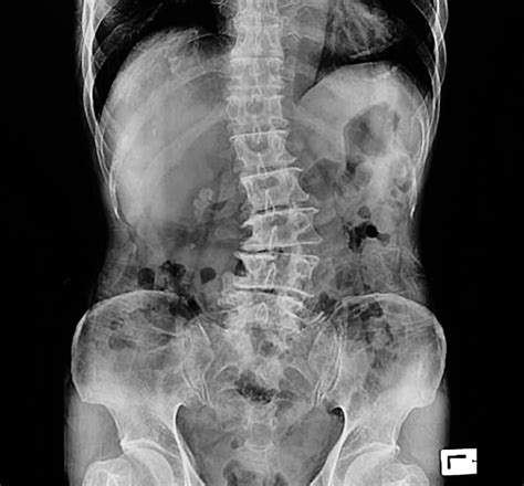 Scoliosis: What is it? - London Bridge Orthopaedics