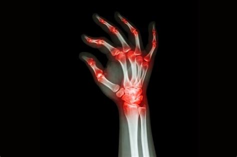 How to Prevent Arthritis in Hands - Symptoms and Prevention