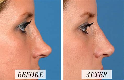 What Is Nonsurgical Rhinoplasty? Risks and Results of Nose Fillers | Allure