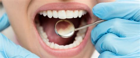 Dental Crown Problems and How to Avoid Them | National Dental Care / DB ...