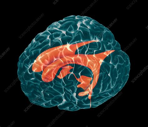 Ventricles of brain, MRI - Stock Image - P332/0374 - Science Photo Library