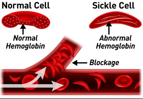 Treating Sickle Cell Anaemia - rafaMALL