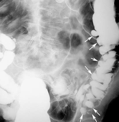 Diverticulosis