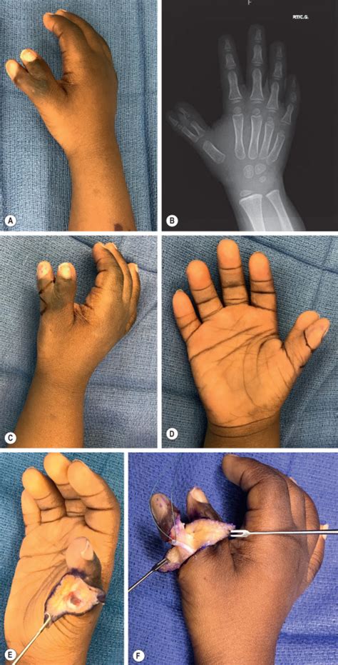 Polydactyly Reconstruction | Plastic Surgery Key