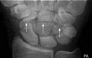 Capitate fracture