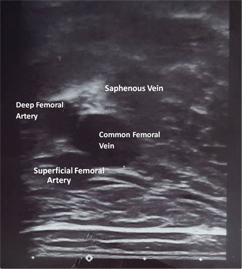 Doppler ultrasound images of the lower right limb showing a superficial ...