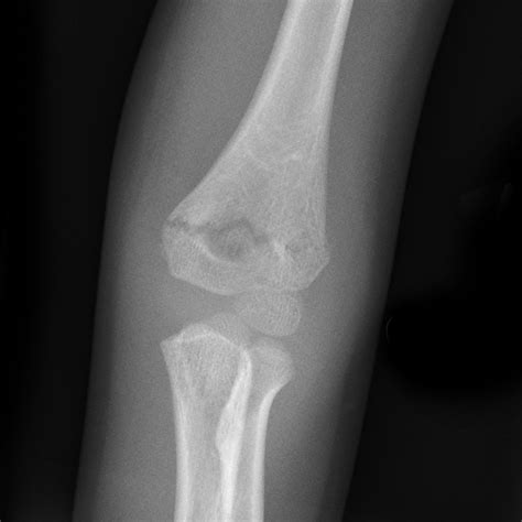 Supracondylar fracture | Image | Radiopaedia.org