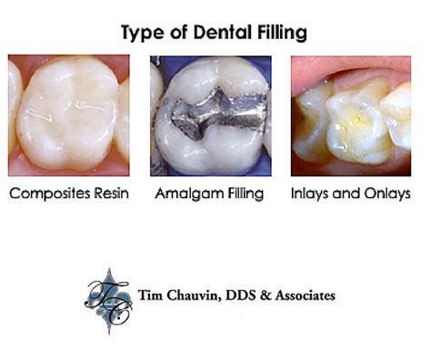 tooth colored fillings Archives - Dr Chauvin