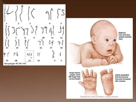 Chromosomal Abnormalities - Schizophrenia