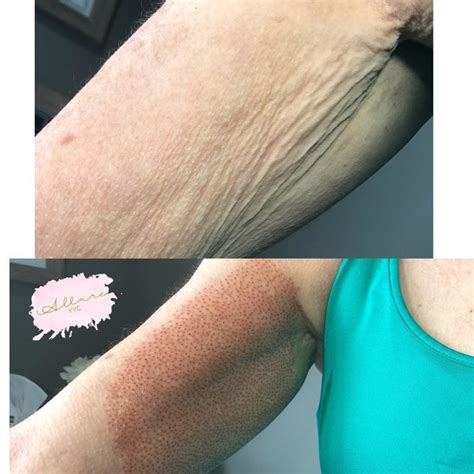 Flabby Arms Skin Tightening in Tucson - Fibroblast PlasmaAlternatives in Health Care Detox ...