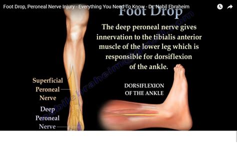 Foot Drop, Peroneal Nerve Injury — OrthopaedicPrinciples.com