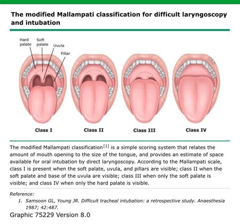 Mallampati Classification Airway Obstruction | Basic anatomy and ...