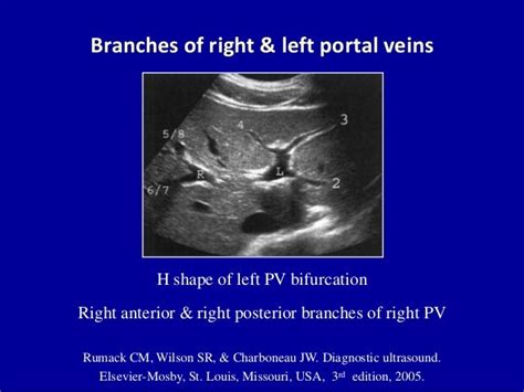 Doppler ultrasound of the portal system - Normal findings