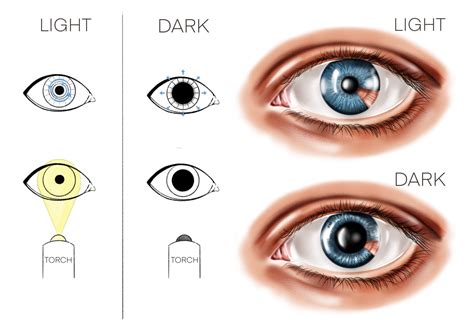 Aniridia: for patients - Gene Vision