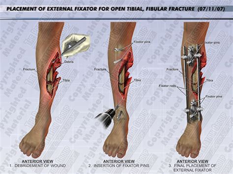 External Fixator Placement | Medical Legal Illustration