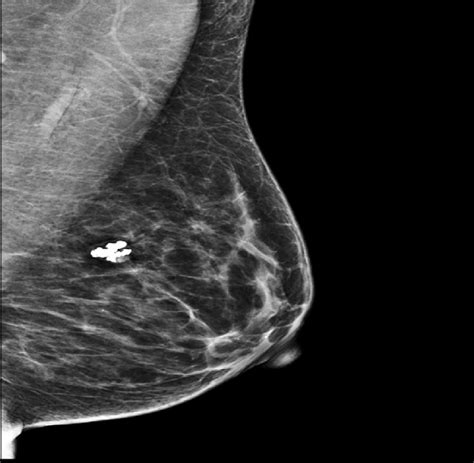 Benign osseous metaplasia of the breast: Case report. - Abstract - Europe PMC