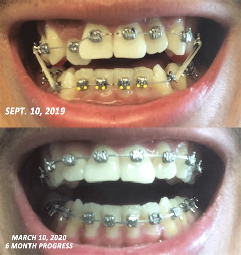 More than happy with my progress! : braces