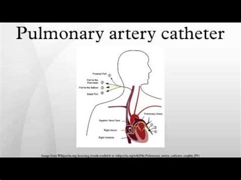 Pulmonary artery catheter - YouTube