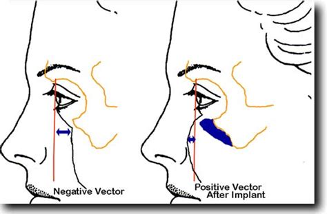 Nasojugal crease, tear trough deformity, nasojugal groove, bags under ...