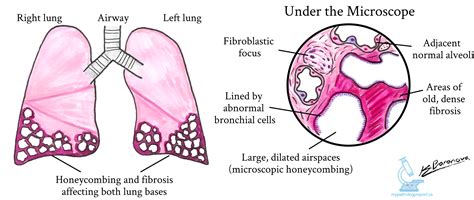 Usual interstitial pneumonia (UIP) | MyPathologyReport.ca