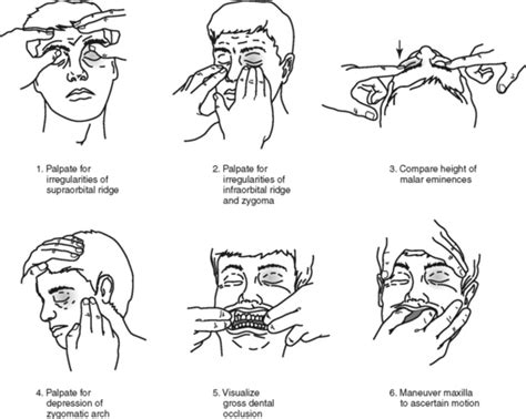 MAXILLOFACIAL TRAUMA | Musculoskeletal Key