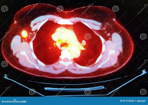 Pet Ct Scan Breast Cancer Metastatic Disease Stock Photo - Image of ...