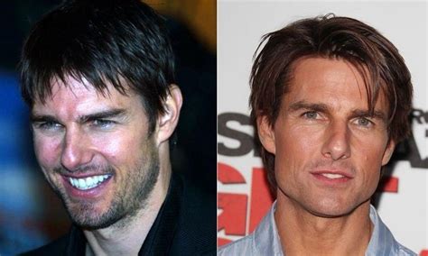 Tom Cruise before and after plastic surgery 06 – Celebrity plastic ...