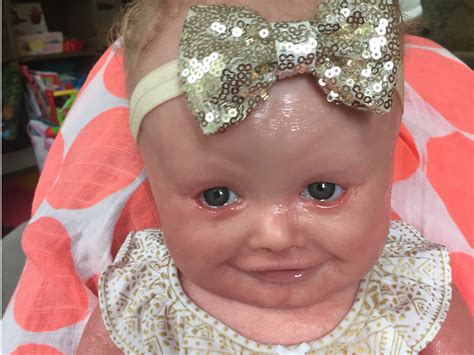 Baby girl has a rare skin condition called harlequin ichthyosis - Business Insider