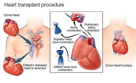 Heart Transplant - Contraindications, Procedure, Cost