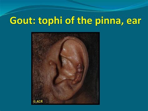 Tophus Ear