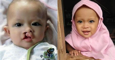 Cara Tepat untuk Memenuhi Nutrisi Anak Bibir Sumbing