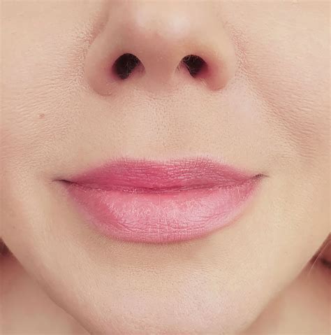 Lip Wrinkle Treatment Abu Dhabi - Lip Filler, Laser Lip Rejuvenation