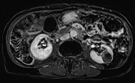 Angiomyolipoma (AML) of kidney - Body MR Case Studies - CTisus CT Scanning