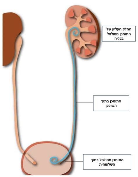 אבנים בדרכי השתן - ד"ר דור גולומב