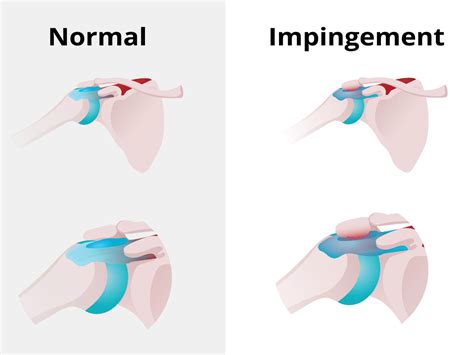 érett Helyezni Meredek lejtő fix shoulder impingement Rugalmasság lekvár Gyors