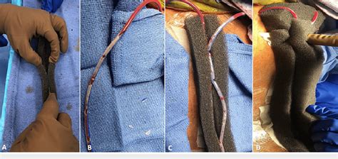 Preparation of the drains and incisional vacuum dressing followed by... | Download Scientific ...