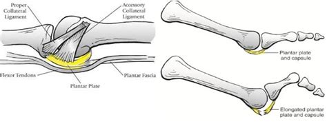 Condition Spotlight: Plantar Plate Injuries - Watsonia Podiatry