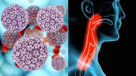 5 Things to Know About HPV-Related Throat Cancer | Everyday Health