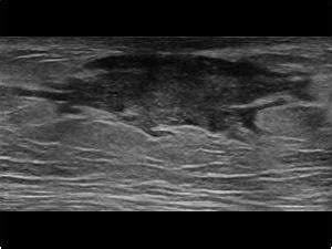 Breast and Axilla | 5.8 Male breast : Case 5.8.1 Gynaecomastia | Ultrasound Cases