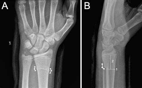 Cureus | A Review of Pediatric Distal Radius Buckle Fractures and the Current Understanding of ...