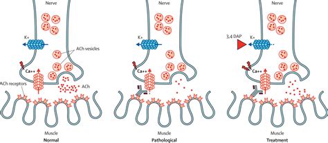 Lambert-Eaton syndrome causes, symptoms, diagnosis, treatment & prognosis