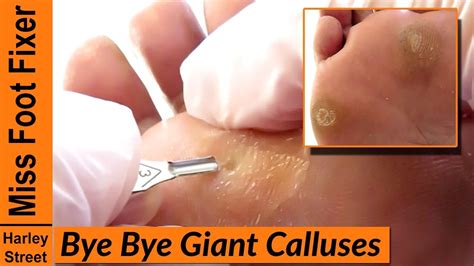 SATISFYING THICKEST AND GIANT CALLUSES REMOVAL - YouTube