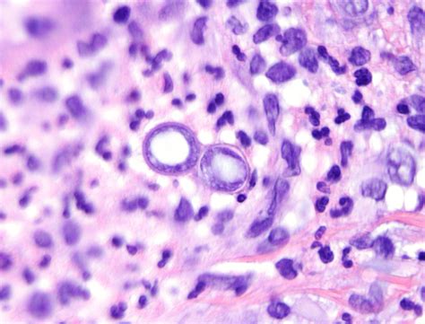 Blastomycosis | Dermatopathology